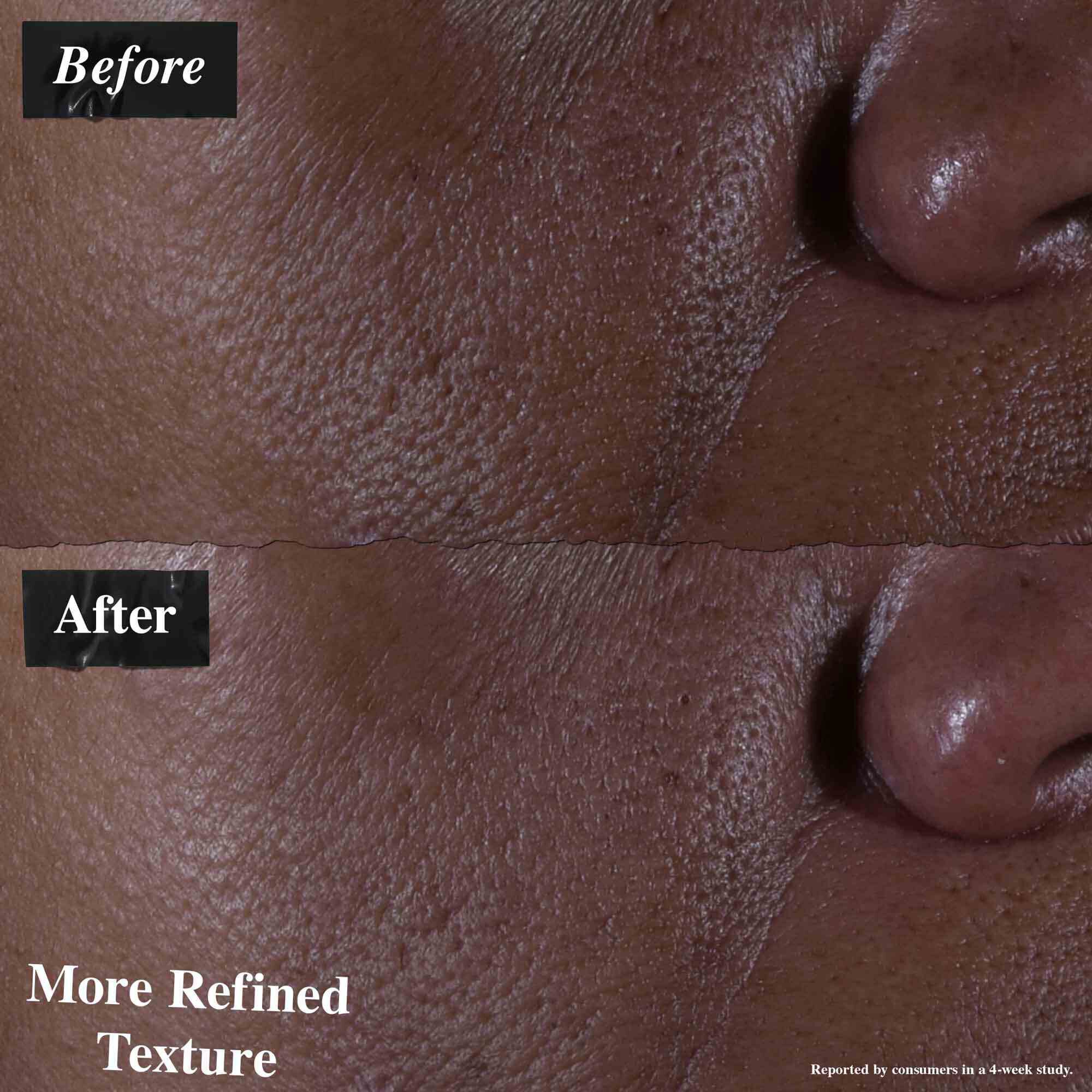 Poređenje pre i posle koje pokazuje kožu tretiranu Ultra Pure 9.8% Glycolic Acid Serum. Slika „pre” pokazuje neujednačenu teksturu, dok slika „posle” pokazuje poboljšanu teksturu.