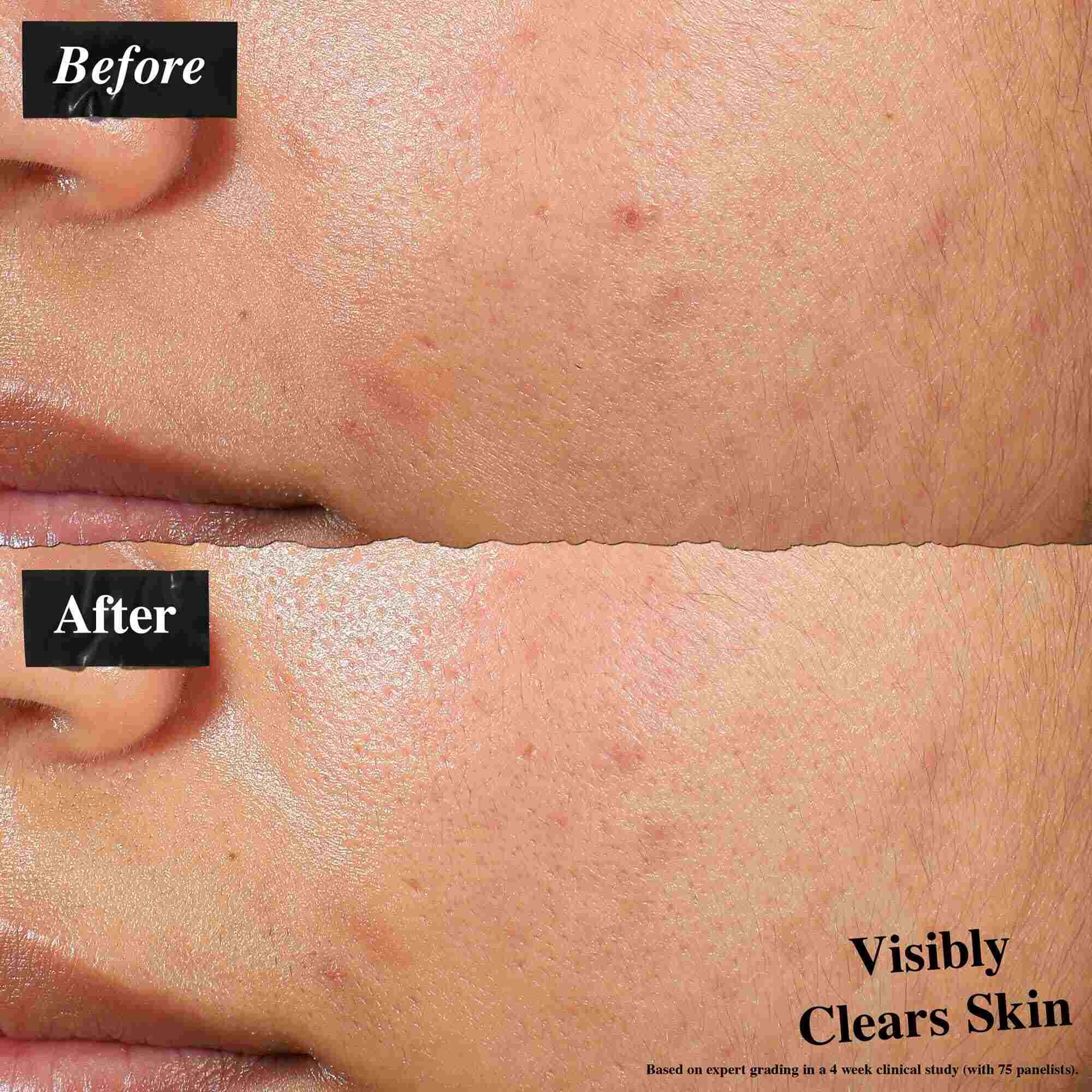 Poređenje pre i posle koje pokazuje kožu tretiranu Expertly Clear Blemish-Treating & Preventing Lotion. Slika „pre” pokazuje nepravilnosti i neujednačenu teksturu kože, dok slika „posle” pokazuje vidno čistiju kožu.
