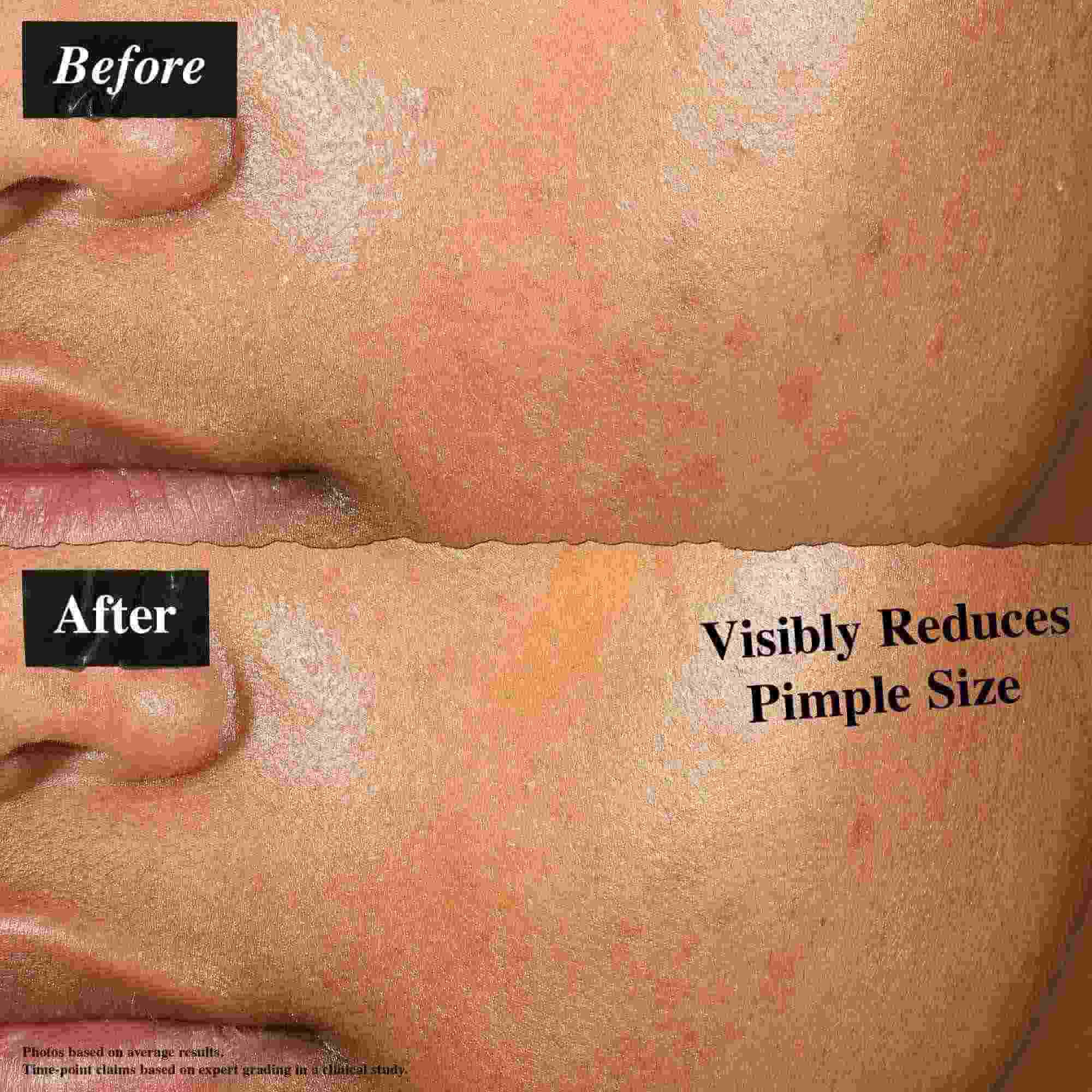 Poređenje pre i posle koje prikazuje kožu tretiranu Truly-Targeted Blemish-Clearing Solutionom. Slika "pre" prikazuje vidljive bubuljice, dok slika "posle" prikazuje smanjenu veličinu bubuljica.