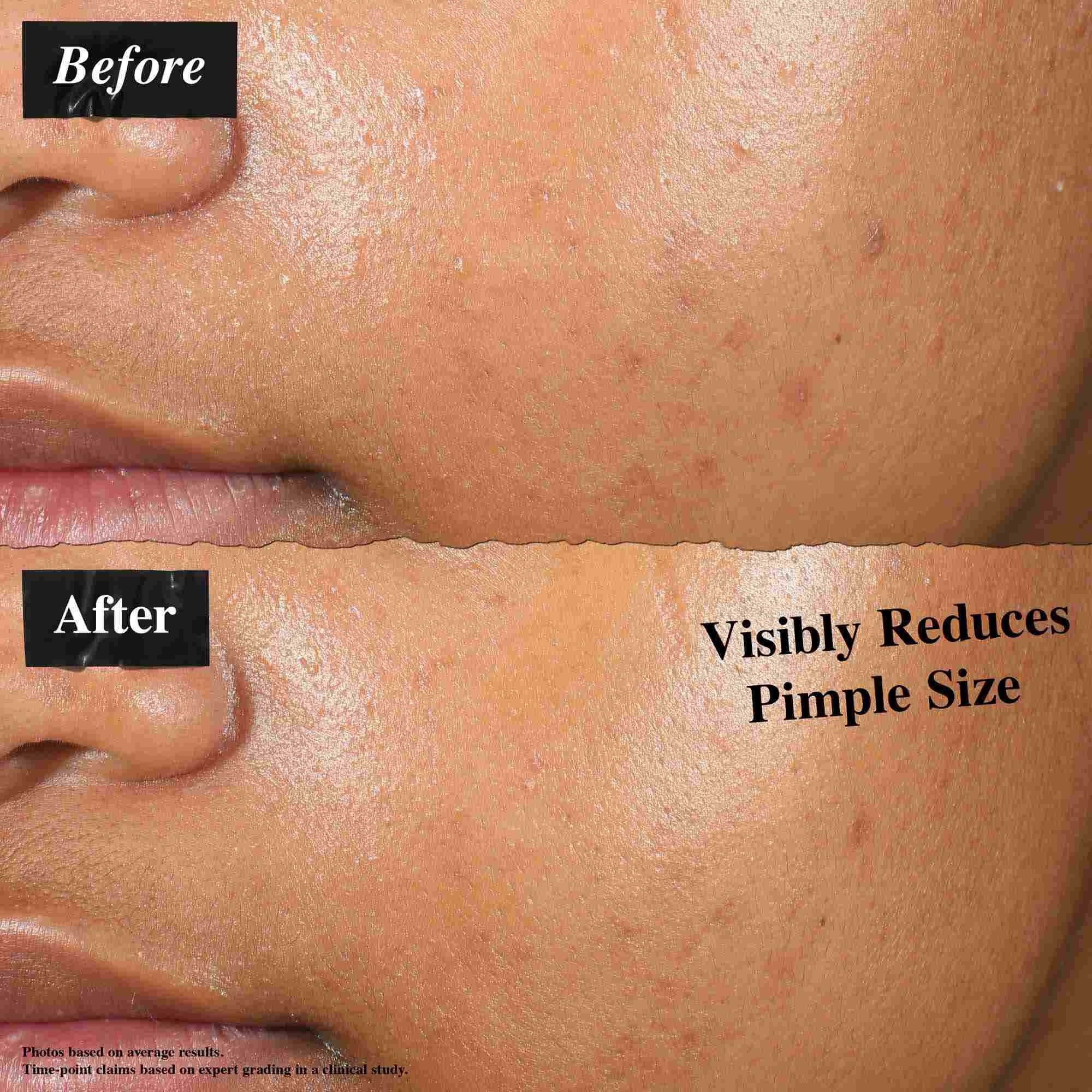 Poređenje pre i posle koje prikazuje kožu tretiranu Truly-Targeted Blemish-Clearing Solutionom. Slika "pre" prikazuje vidljive bubuljice, dok slika "posle" prikazuje smanjenu veličinu bubuljica.