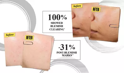 Comparison image showing before and after results of acne treatment. The "before" photos display skin with blemishes, while the "after" photos show clearer skin, highlighting 100% of users experienced acne clearing and a 31% reduction in post-blemish marks.