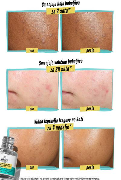 Alt text: A comparison image showing the effects of a skincare product on acne. The top two panels show before and after results of reduced pimple color in 2 hours, with noticeable color improvement. The middle panels depict before and after results of reduced pimple size in 24 hours, showing smaller pimples after treatment. The bottom panels illustrate before